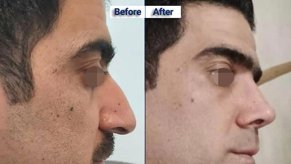عکس قبل و بعد جراحی بینی دکتر علیرضا مزارعی
