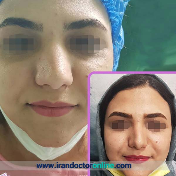 نمونه کار جراحی زیبایی بینی دکتر پریسا نظرپور
