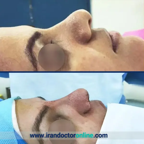 نمونه جراحی بینی دکتر سخی 1
