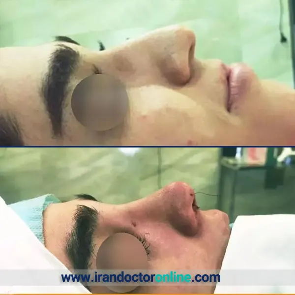 نمونه جراحی بینی دکتر سخی 2