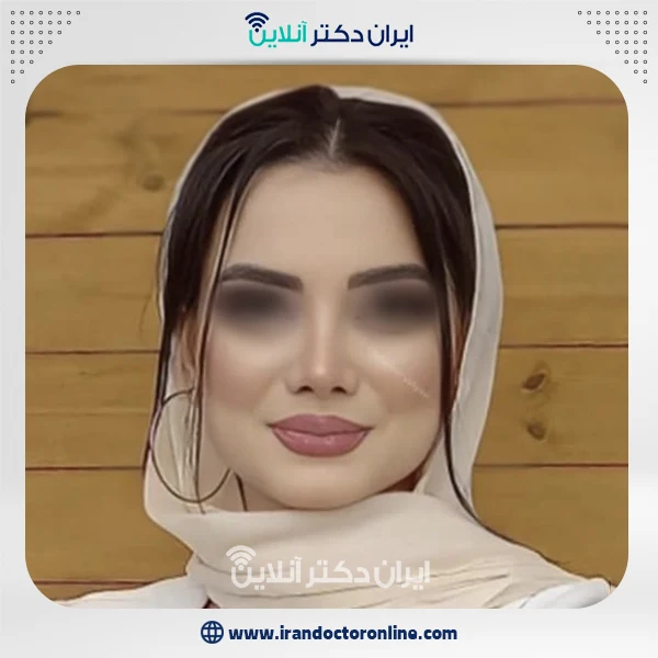 عمل زیبایی بینی دکتر یحیوی تهران