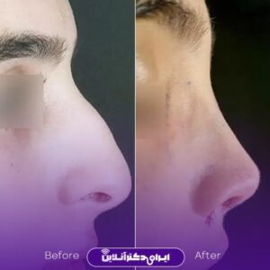 نمونه عمل جراحی بینی دکتر عباس زاده تهران