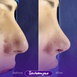 نمونه جراحی زیبایی بینی دکتر عرفانیان تقوائی