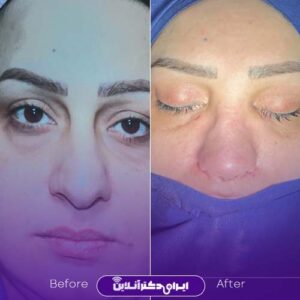 تصویر جراحی زیبایی بینی دکتر بختیاری تهران