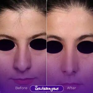 عکس جراحی زیبایی بینی دکتر شریعت اصفهان
