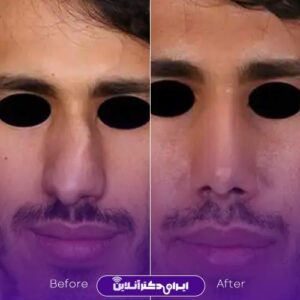 تصویر عمل رینوپلاستی بینی مردانه دکتر شریعت اصفهان