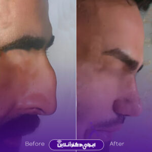 نمونه عمل جراحی بینی دکتر سلیمان زندی شهر اصفهان 3