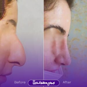 نمونه رینوپلاستی بینی زنانه دکتر سلیمان زندی اصفهان