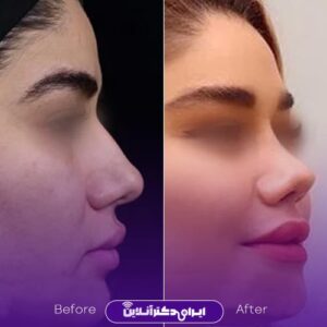 نمونه عمل بینی دکتر دریانی در تهران
