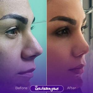 نمونه جراحی زیبایی بینی دکتر نیلوفر رحیمی پور در تهران