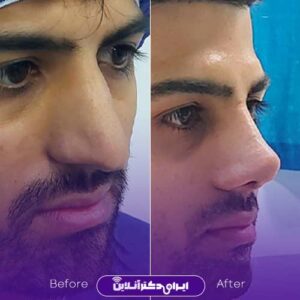 نمونه عمل بینی مردانه دکتر رحیمی پور تهران