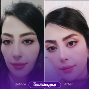 نمونه کار دکتر وکیلی جراح بینی مشهد