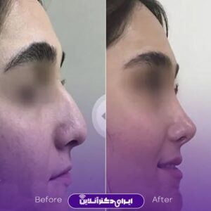 نمونه عمل رینوپلاستی دکتر ایرج وکیلی مشهد