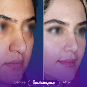 عکس جراحی زیبایی بینی دکتر سام تویسرکانی تهران