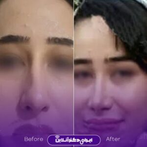 نمونه رینوپلاستی بینی زنانه دکتر دادگستر تهران