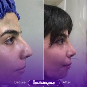 نمونه کار دکتر ایرج وکیلی جراح بینی مشهد
