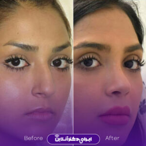 نمونه کار دکتر علی سرابی جراح عمل بینی مشهد