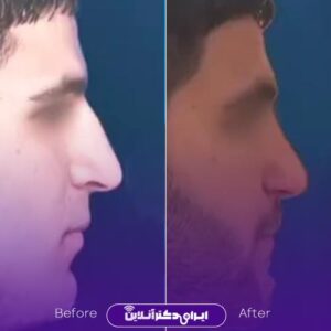 نمونه عمل بینی دکتر علی حسینی رشت