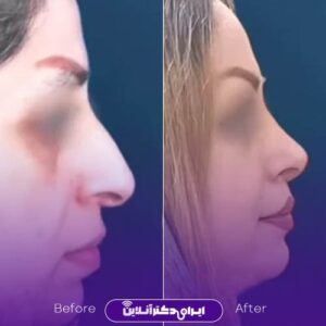 عکس جراحی بینی دکتر حسینی واجاری شهر رشت