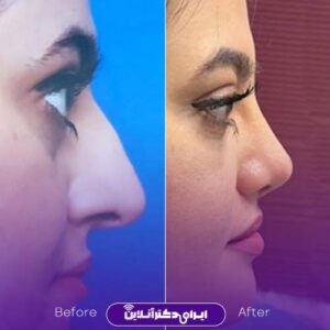 نمونه عمل بینی زنانه دکتر واجاری رشت