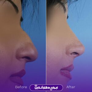 عکس جراحی زیبایی بینی دکتر حاتمی پور