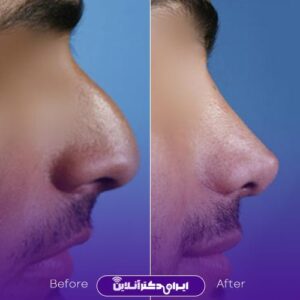 نمونه کارهای دکتر ابراهیم حاتمی پور جراح بینی شیراز