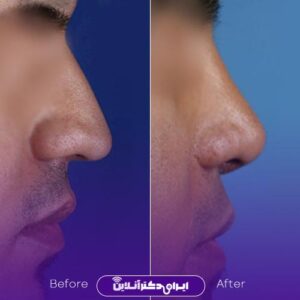 نمونه کارهای دکتر حاتمی پور جراحی بینی شیراز