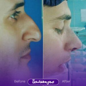عکس نمونه عمل بینی مردانه نسیم کوشا رشت