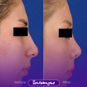 نمونه کارهای دکتر نوشین فتوحی جراح بینی
