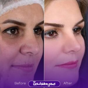 نمونه عمل بینی دکتر سعید رضا توفیقی شیراز