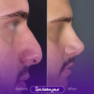 نمونه عمل های بینی دکتر سعیدرضا توفیقی