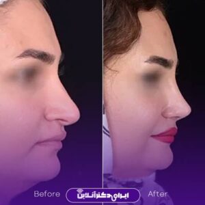 نمونه عمل جراحی زیبایی بینی دکتر پوستچی شیراز