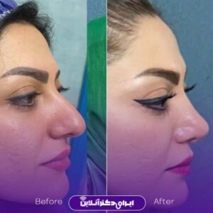 تصویر جراحی زیبایی بینی دکتر نگار جعفری در شیراز