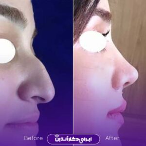نمونه جراحی زیبایی بینی دکتر طریقت رشت