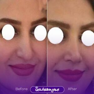 عکس نمونه عمل بینی دکتر سمیه طریقت رشت