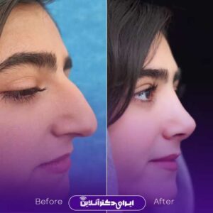 نمونه کار دکتر ابراهیم حاتمی پور جراح بینی شیراز