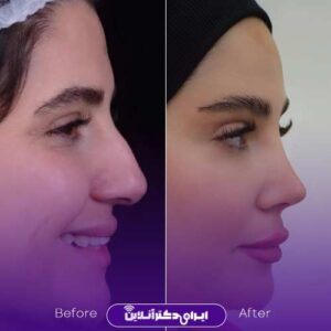 نمونه کارهای دکتر پوستچی شیراز جراح بینی