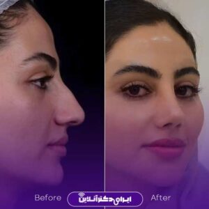 عکس نمونه کارهای عمل بینی دکتر پوستچی شیراز