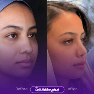 نمونه کارهای جراحی بینی دکتر شاکری شیراز