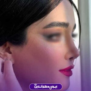 نمونه کار دکتر زهره متدین جراح بینی مشهد