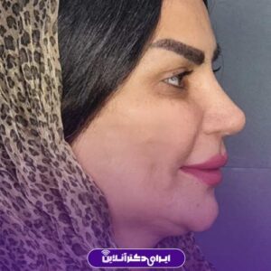 نمونه کار دکتر سعید رضا توفیقی جراح بینی شیراز