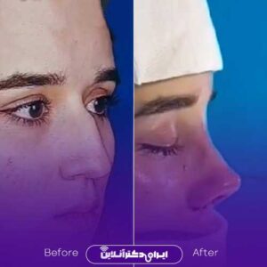 نمونه عمل بینی دکتر متدین مشهد