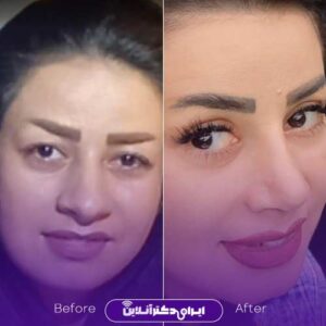 عکس نمونه جراحی زیبایی بینی دکتر زهره متدین