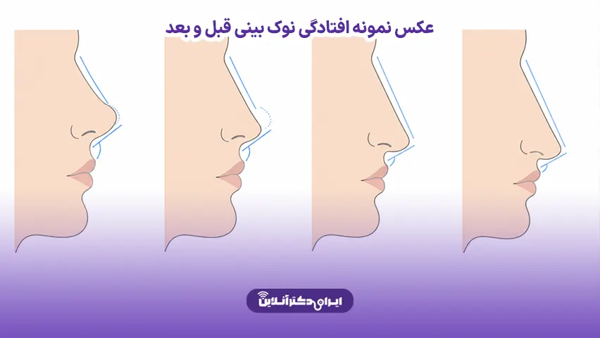 عکس نمونه افتادگی نوک بینی قبل و بعد