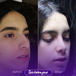 نمونه کار دکتر اشتری جراح بینی تهران