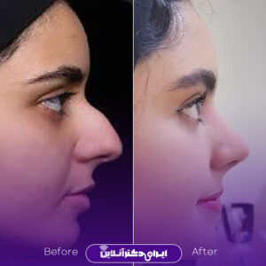 عکس جراحی بینی دکتر راستی