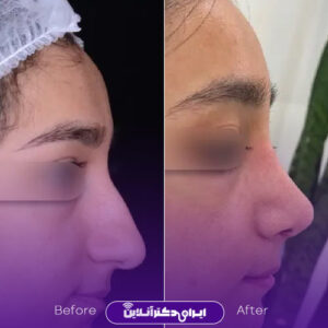 نمونه کار دکتر سولماز قربانی جراح بینی در شیراز