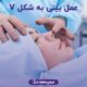 عمل بینی به شکل v