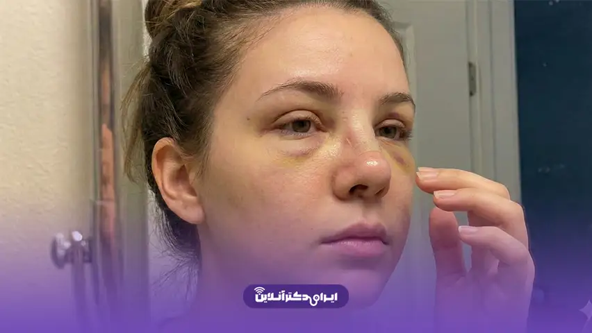 ورم نوک بینی گوشتی بعد از عمل + 9 درمان گرد شدن بینی و تورم 9 عکس ورم بینی بعد از عمل