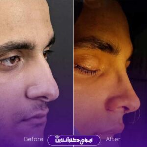 نمونه کار دکتر محمد دهقان جراح بینی در رشت